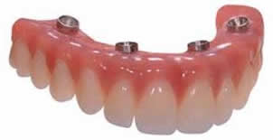 Carico immediato - Toronto bridge / All on four/six