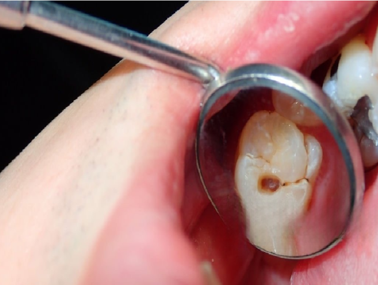 Trattamento conservativo ed endodontico